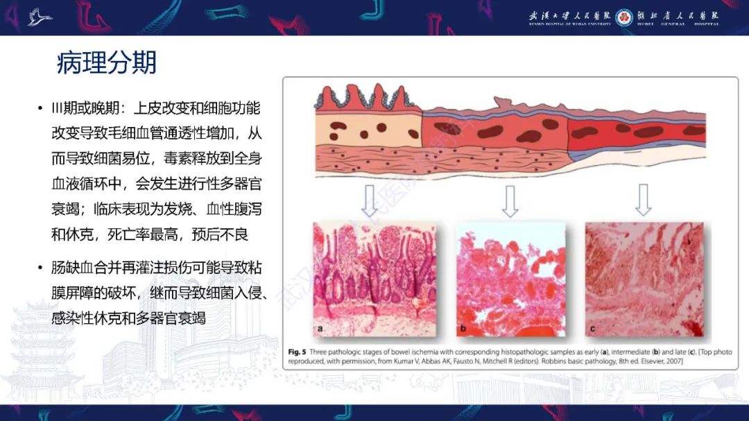 影像PPT - 【PPT】急性肠缺血影像诊断-11
