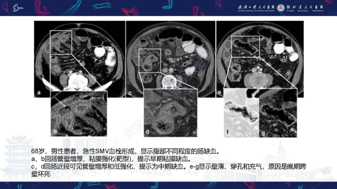 影像PPT - 【PPT】急性肠缺血影像诊断-15