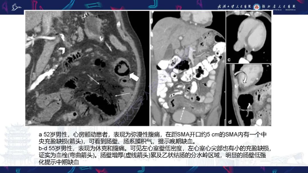 影像PPT - 【PPT】急性肠缺血影像诊断-19