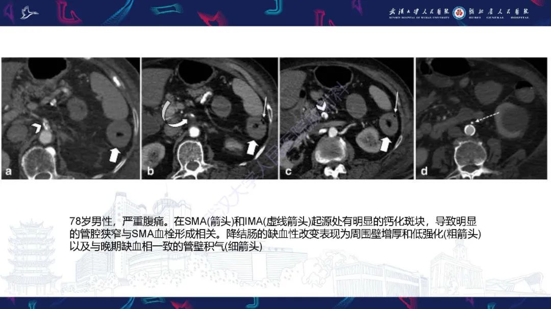 影像PPT - 【PPT】急性肠缺血影像诊断-20