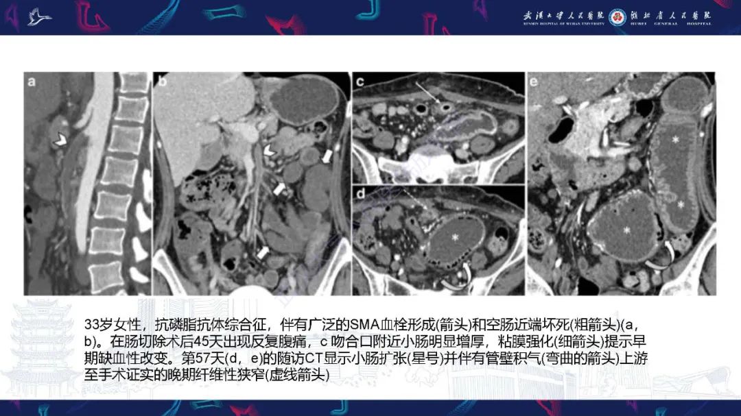 影像PPT - 【PPT】急性肠缺血影像诊断-21