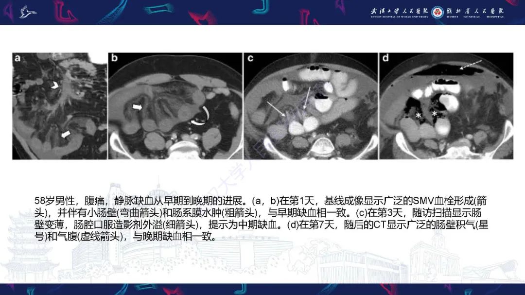 影像PPT - 【PPT】急性肠缺血影像诊断-25