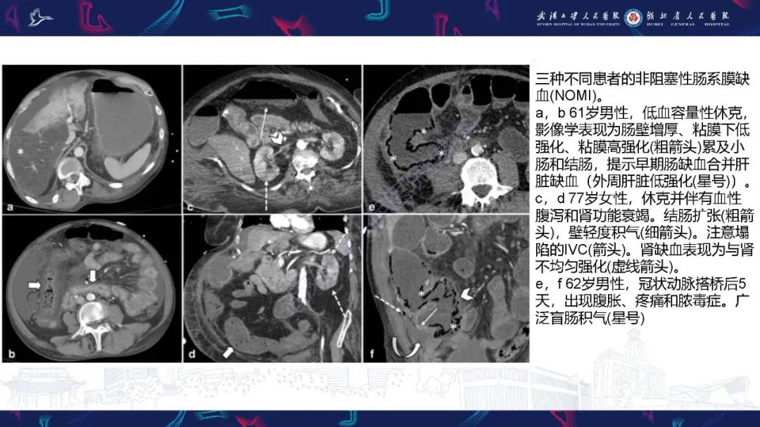 影像PPT - 【PPT】急性肠缺血影像诊断-27