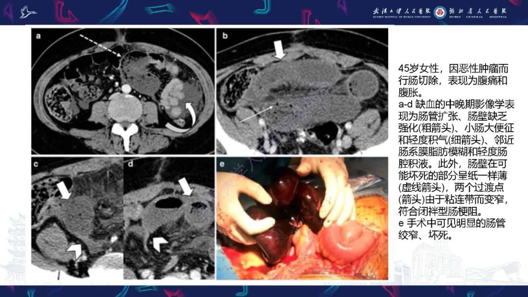 影像PPT - 【PPT】急性肠缺血影像诊断-29