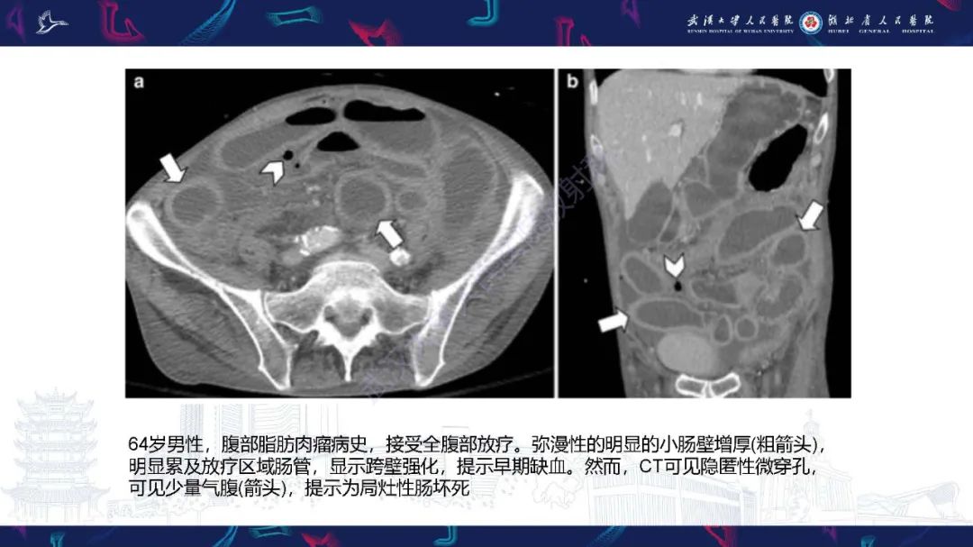 影像PPT - 【PPT】急性肠缺血影像诊断-30