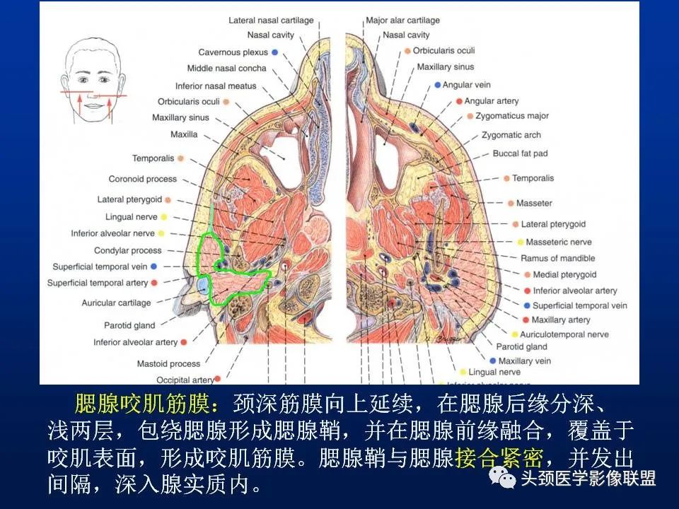 影像PPT - 【PPT】腮腺病变影像学诊断-6