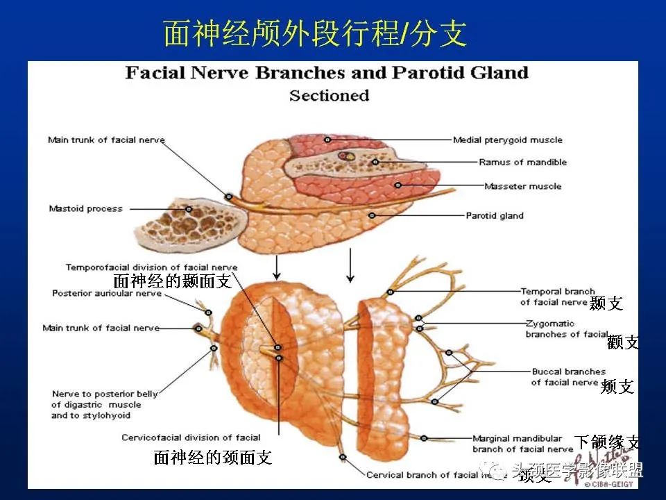 影像PPT - 【PPT】腮腺病变影像学诊断-5
