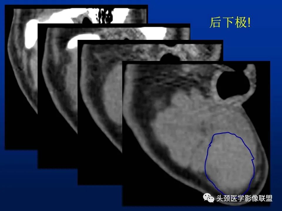 影像PPT - 【PPT】腮腺病变影像学诊断-15