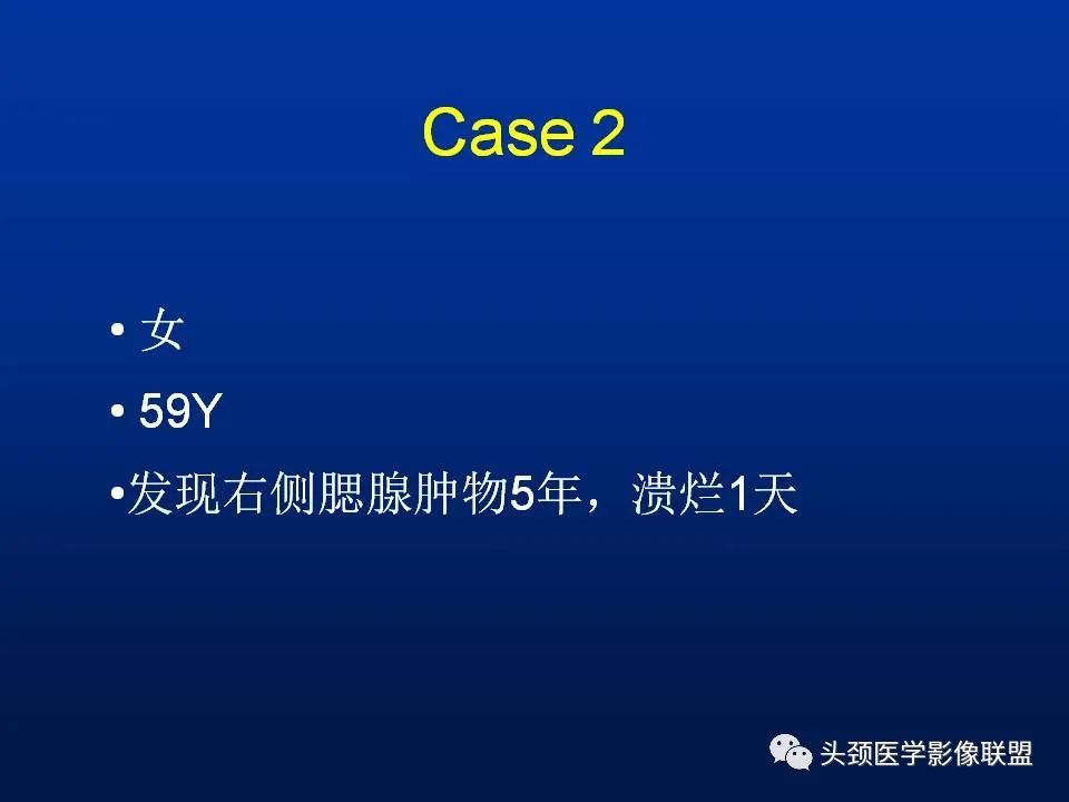 影像PPT - 【PPT】腮腺病变影像学诊断-18
