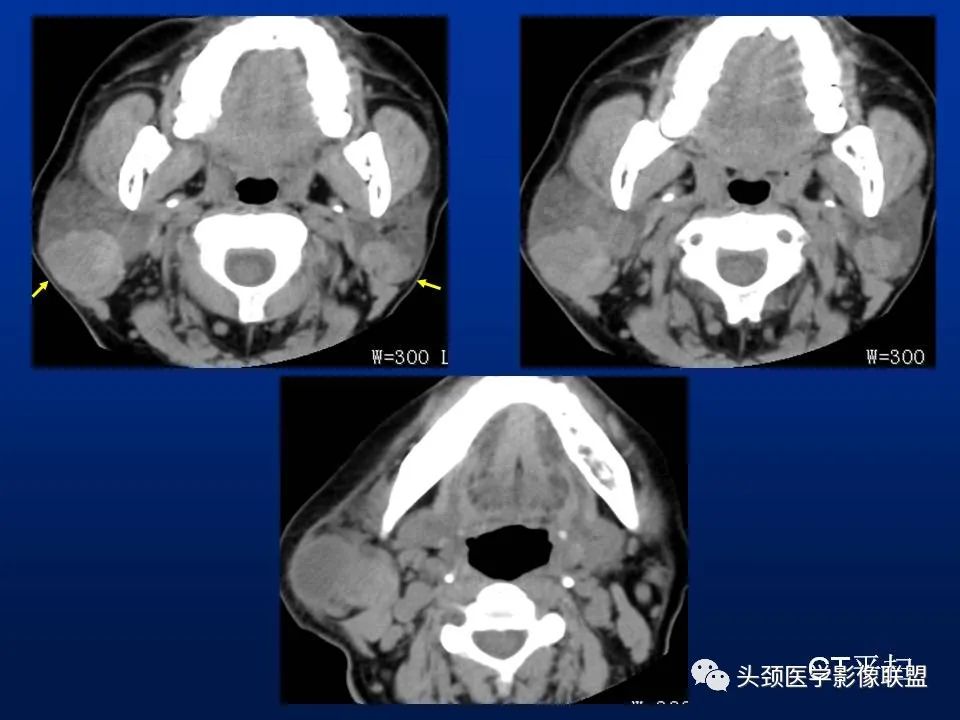 影像PPT - 【PPT】腮腺病变影像学诊断-19