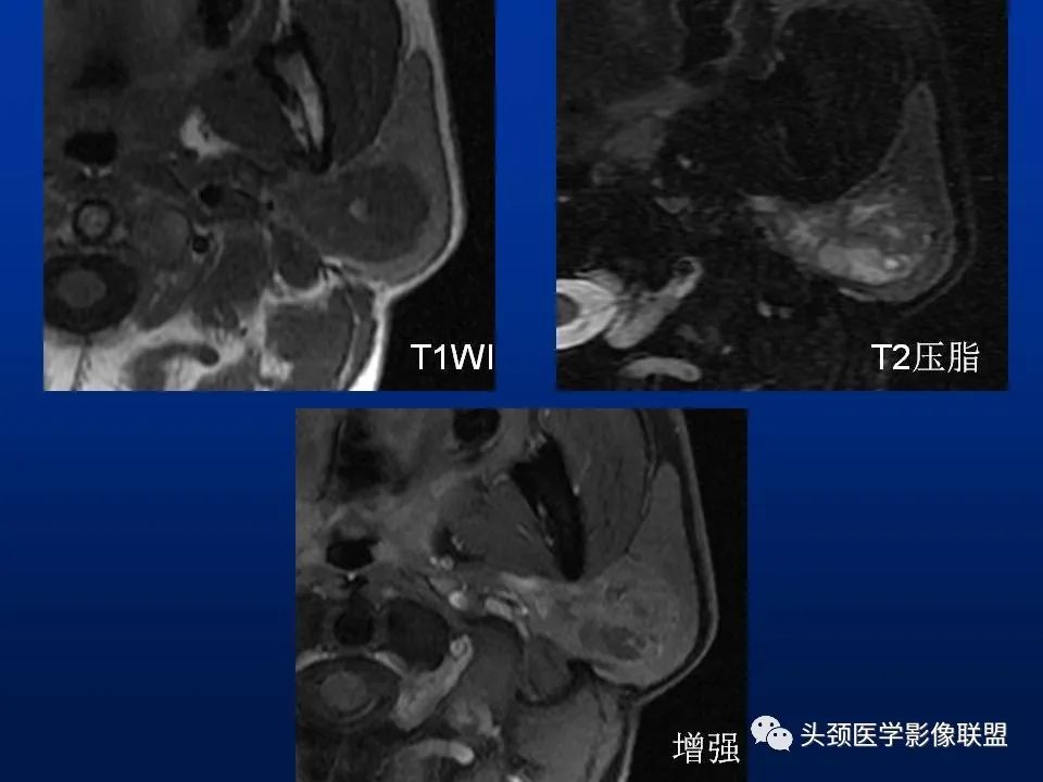 影像PPT - 【PPT】腮腺病变影像学诊断-16