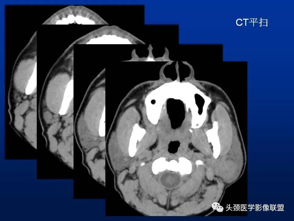 影像PPT - 【PPT】腮腺病变影像学诊断-14