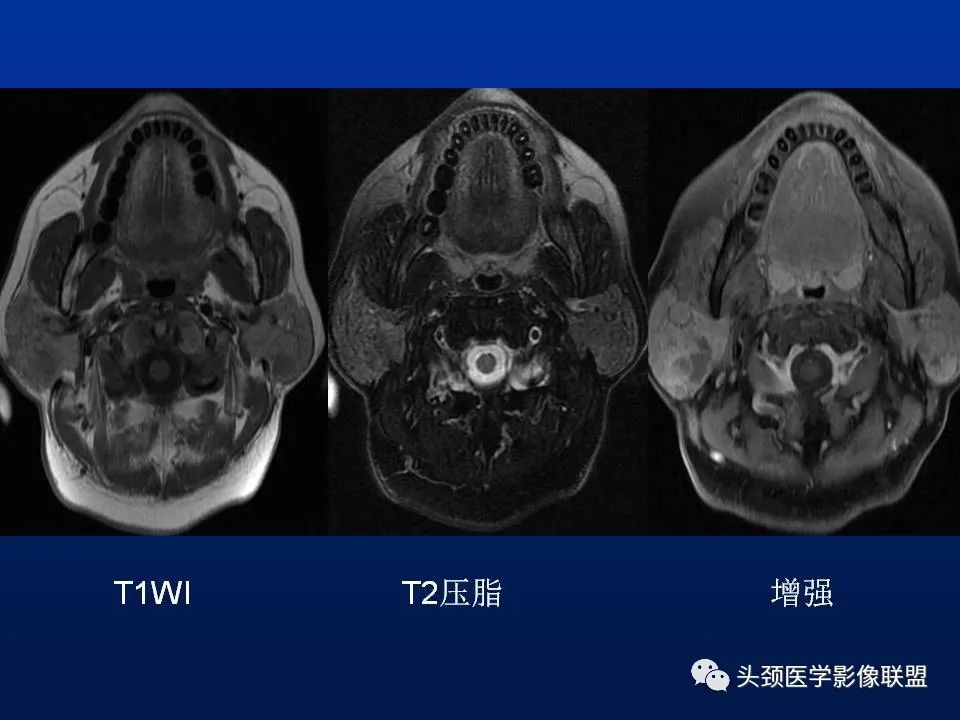 影像PPT - 【PPT】腮腺病变影像学诊断-21