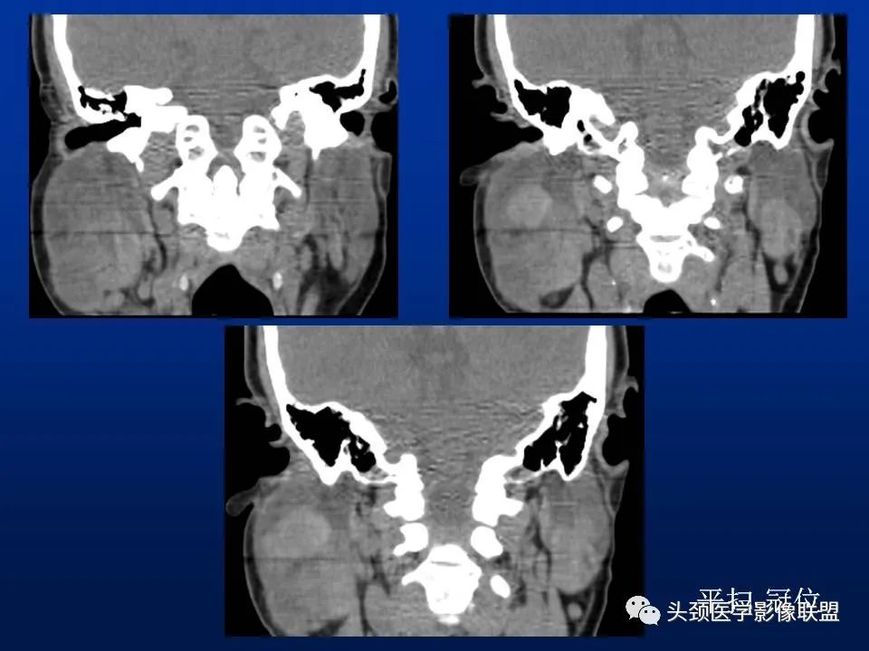 影像PPT - 【PPT】腮腺病变影像学诊断-20