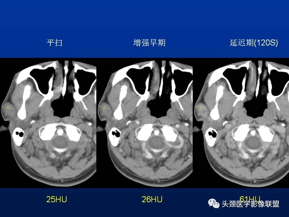 影像PPT - 【PPT】腮腺病变影像学诊断-24