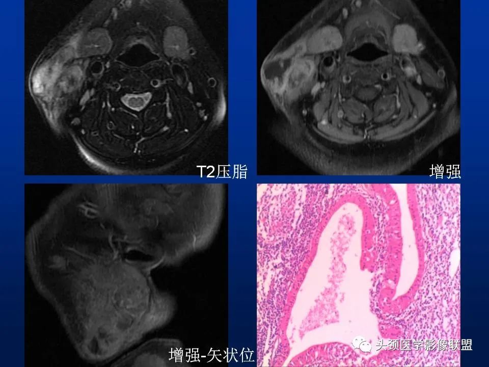 影像PPT - 【PPT】腮腺病变影像学诊断-22