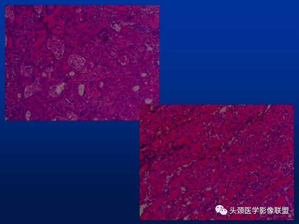 影像PPT - 【PPT】腮腺病变影像学诊断-25