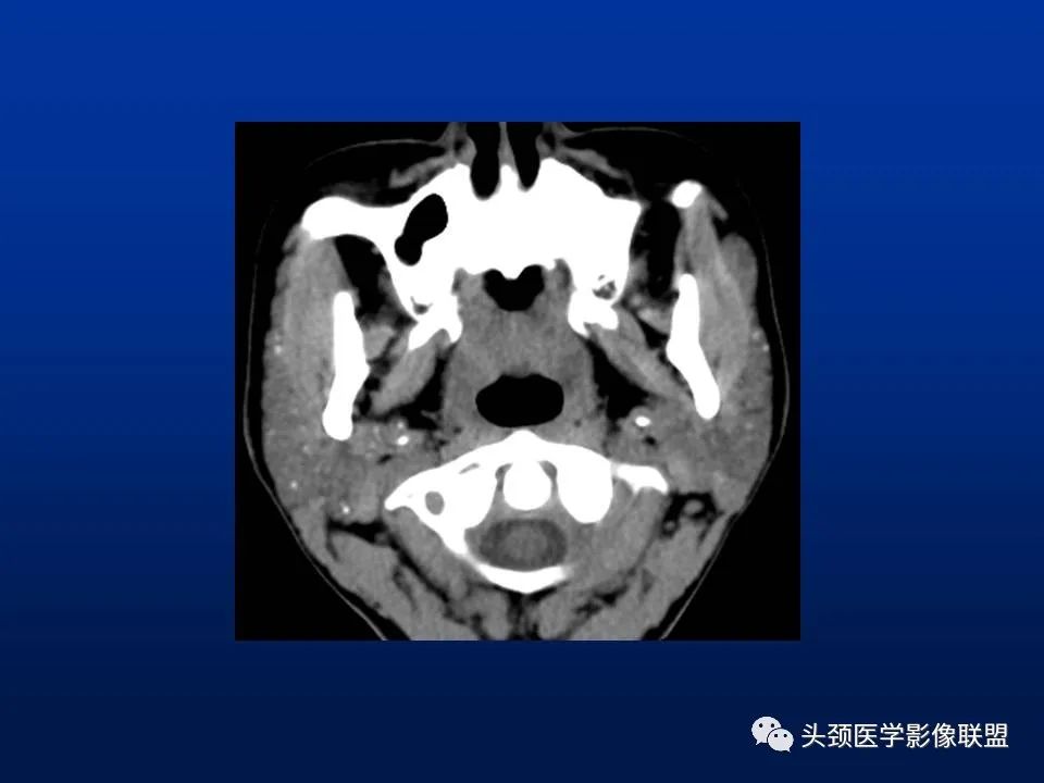 影像PPT - 【PPT】腮腺病变影像学诊断-29