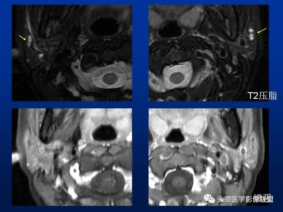 影像PPT - 【PPT】腮腺病变影像学诊断-31