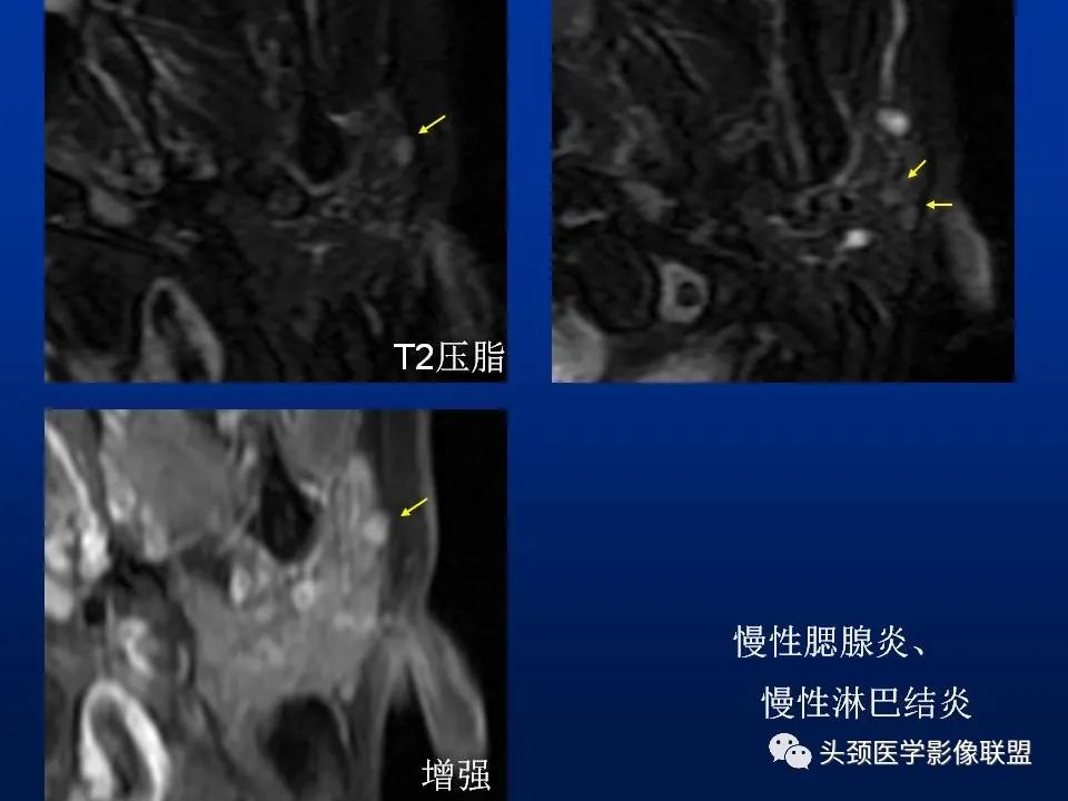 影像PPT - 【PPT】腮腺病变影像学诊断-32