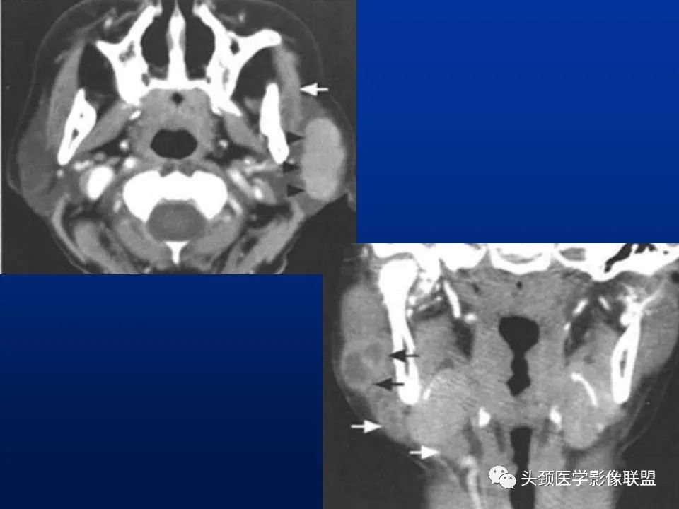 影像PPT - 【PPT】腮腺病变影像学诊断-34