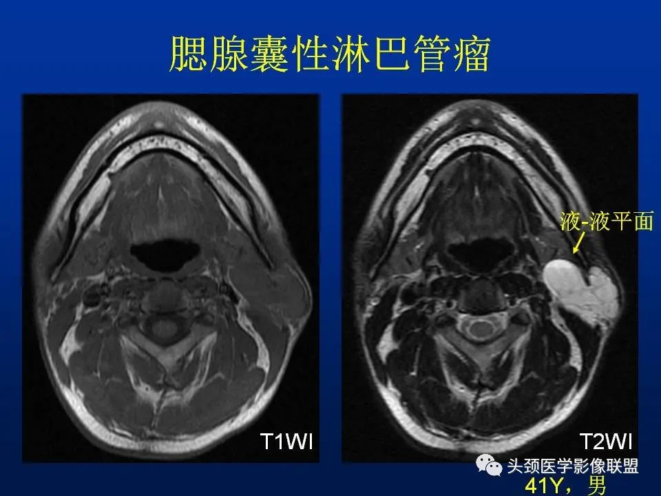 影像PPT - 【PPT】腮腺病变影像学诊断-37