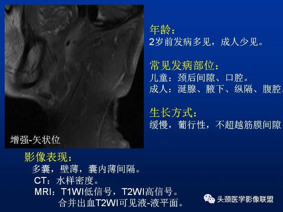 影像PPT - 【PPT】腮腺病变影像学诊断-38