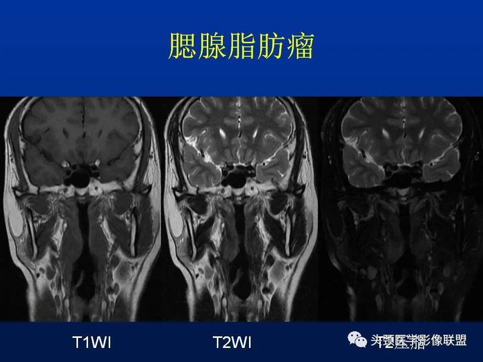 影像PPT - 【PPT】腮腺病变影像学诊断-39