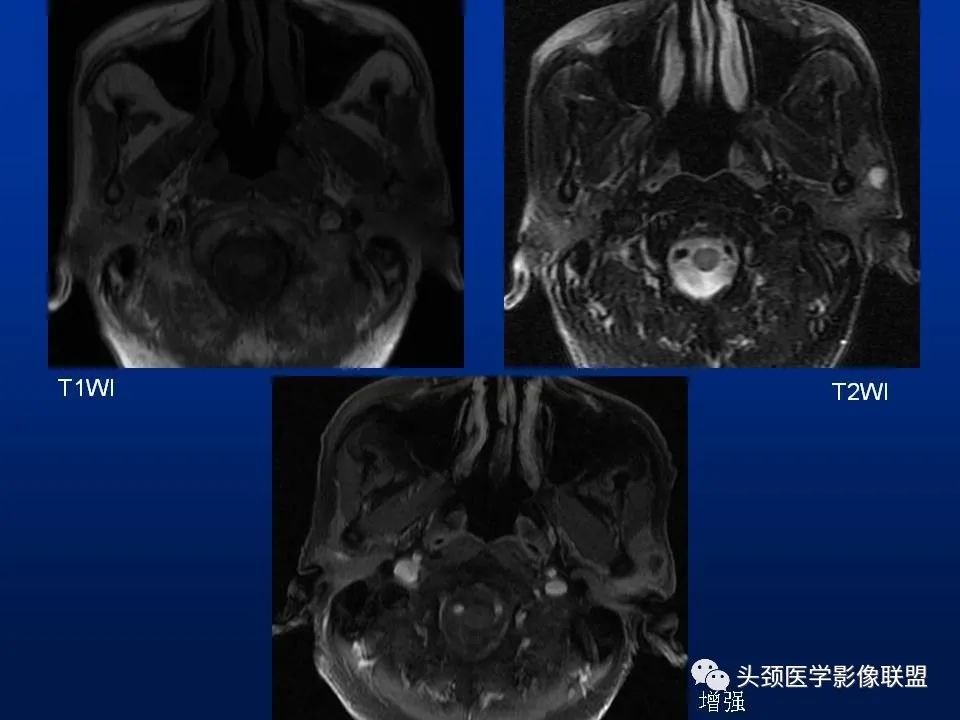 影像PPT - 【PPT】腮腺病变影像学诊断-43
