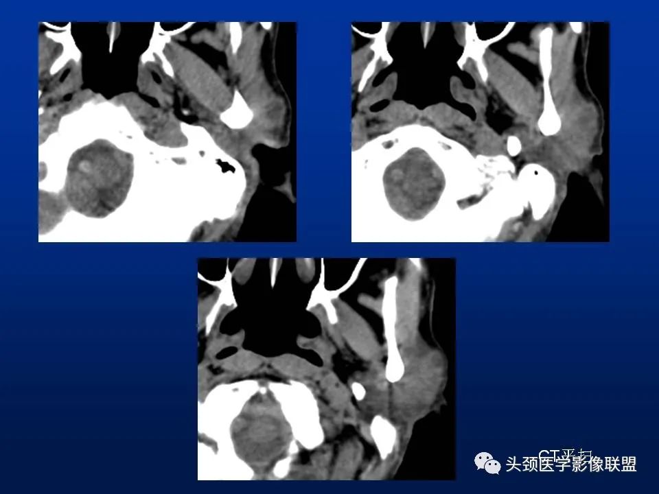 影像PPT - 【PPT】腮腺病变影像学诊断-42