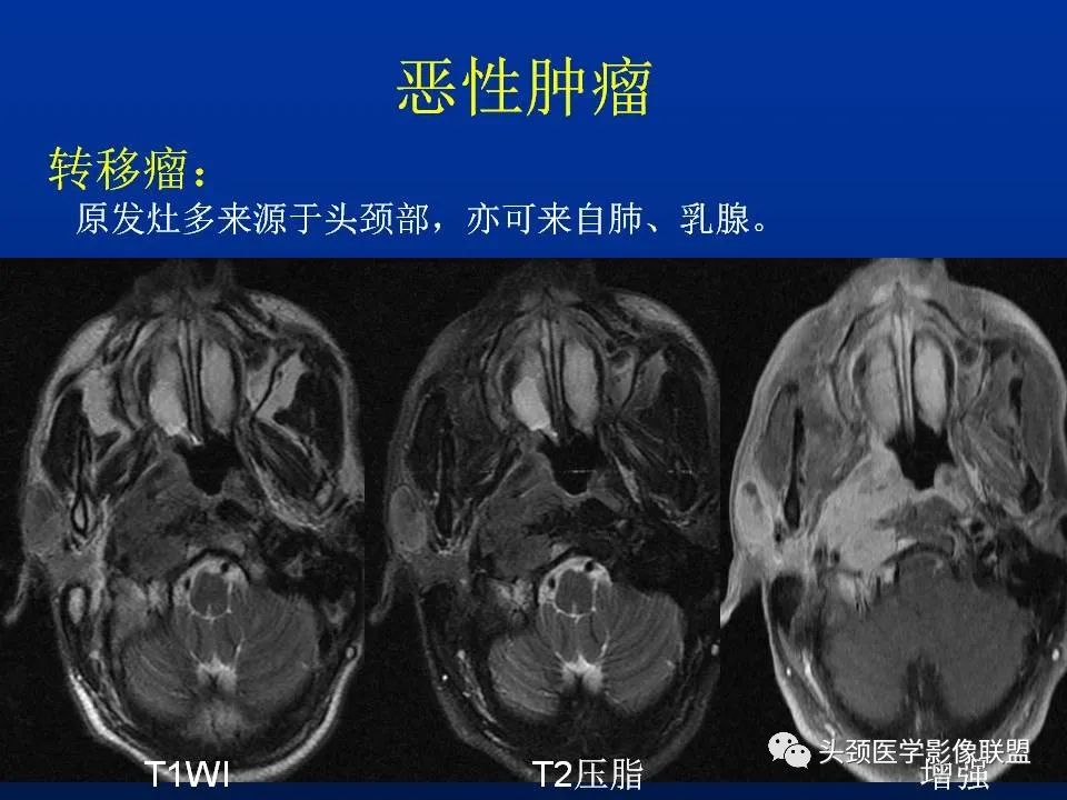 影像PPT - 【PPT】腮腺病变影像学诊断-45