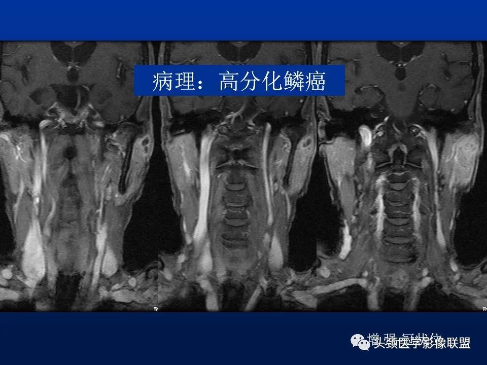 影像PPT - 【PPT】腮腺病变影像学诊断-44