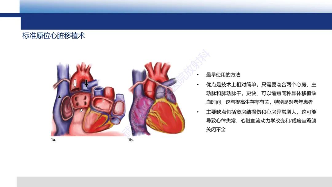 影像PPT - 【PPT】心脏原位移植术后影像学评估-5