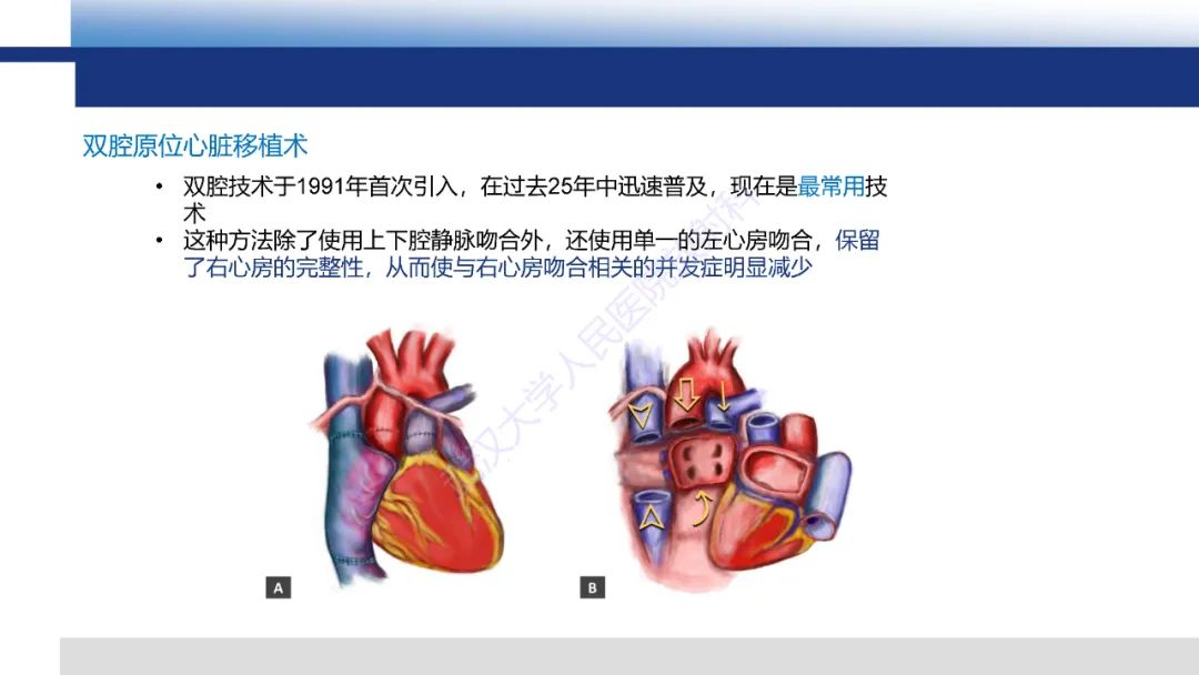 影像PPT - 【PPT】心脏原位移植术后影像学评估-7
