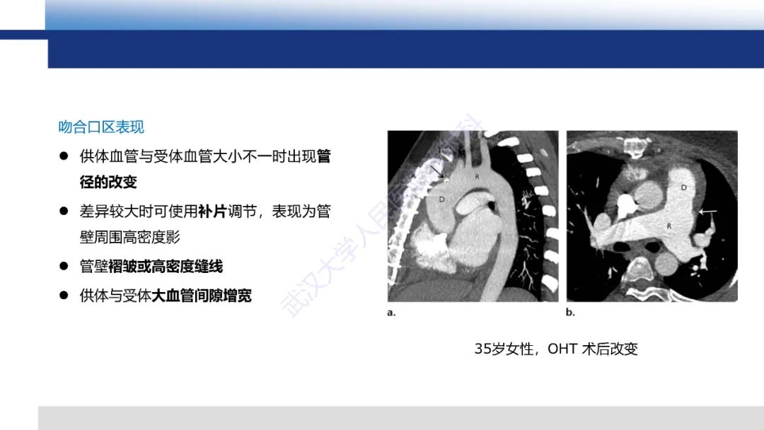影像PPT - 【PPT】心脏原位移植术后影像学评估-10