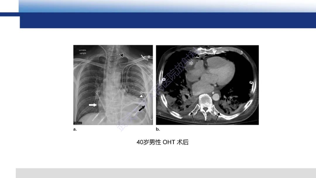 影像PPT - 【PPT】心脏原位移植术后影像学评估-9