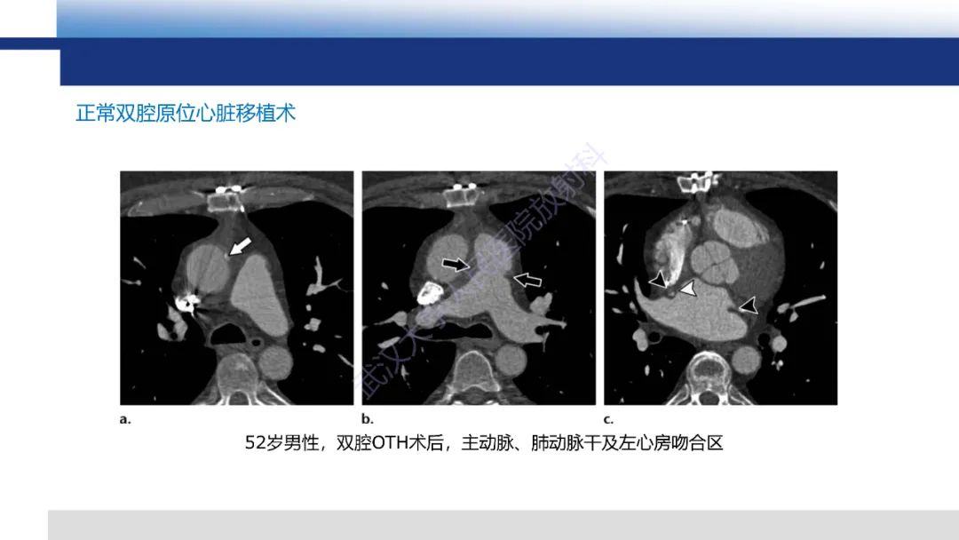 影像PPT - 【PPT】心脏原位移植术后影像学评估-11