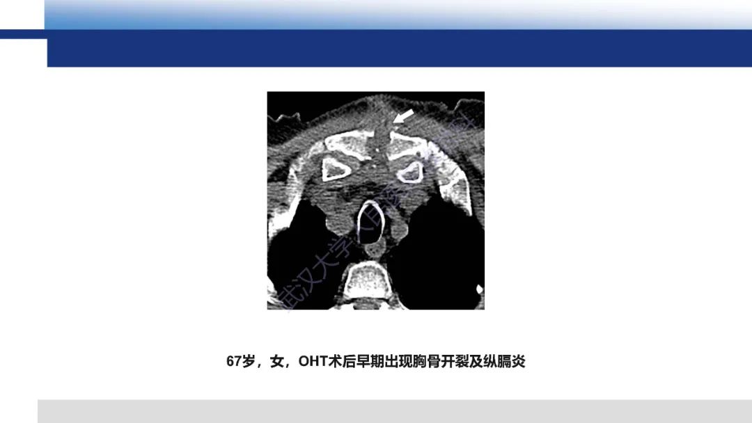 影像PPT - 【PPT】心脏原位移植术后影像学评估-14