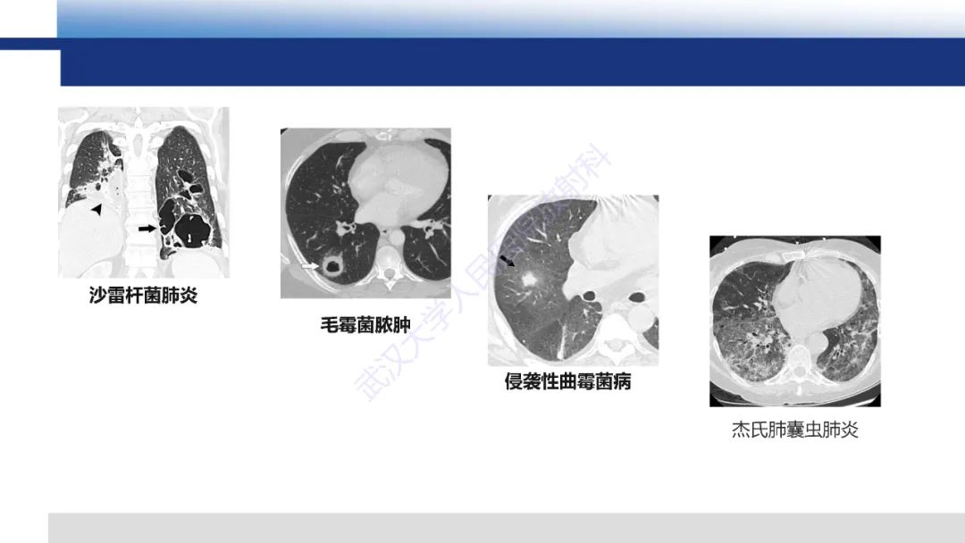 影像PPT - 【PPT】心脏原位移植术后影像学评估-16