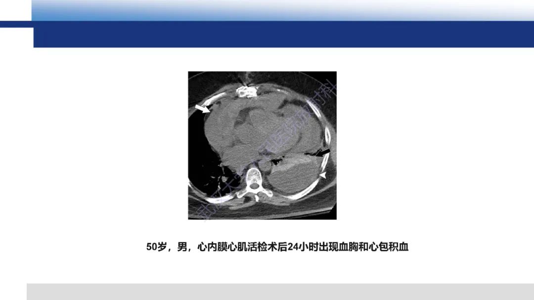 影像PPT - 【PPT】心脏原位移植术后影像学评估-20