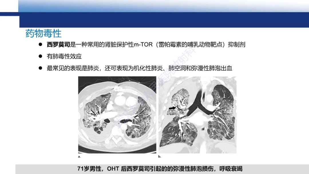 影像PPT - 【PPT】心脏原位移植术后影像学评估-24