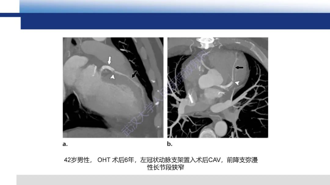 影像PPT - 【PPT】心脏原位移植术后影像学评估-27