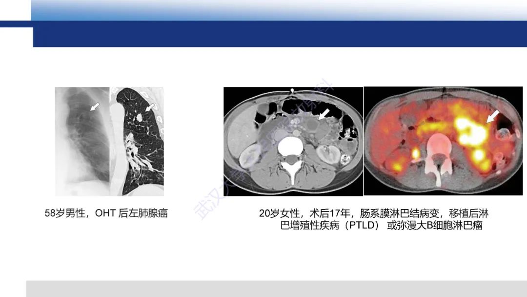 影像PPT - 【PPT】心脏原位移植术后影像学评估-29