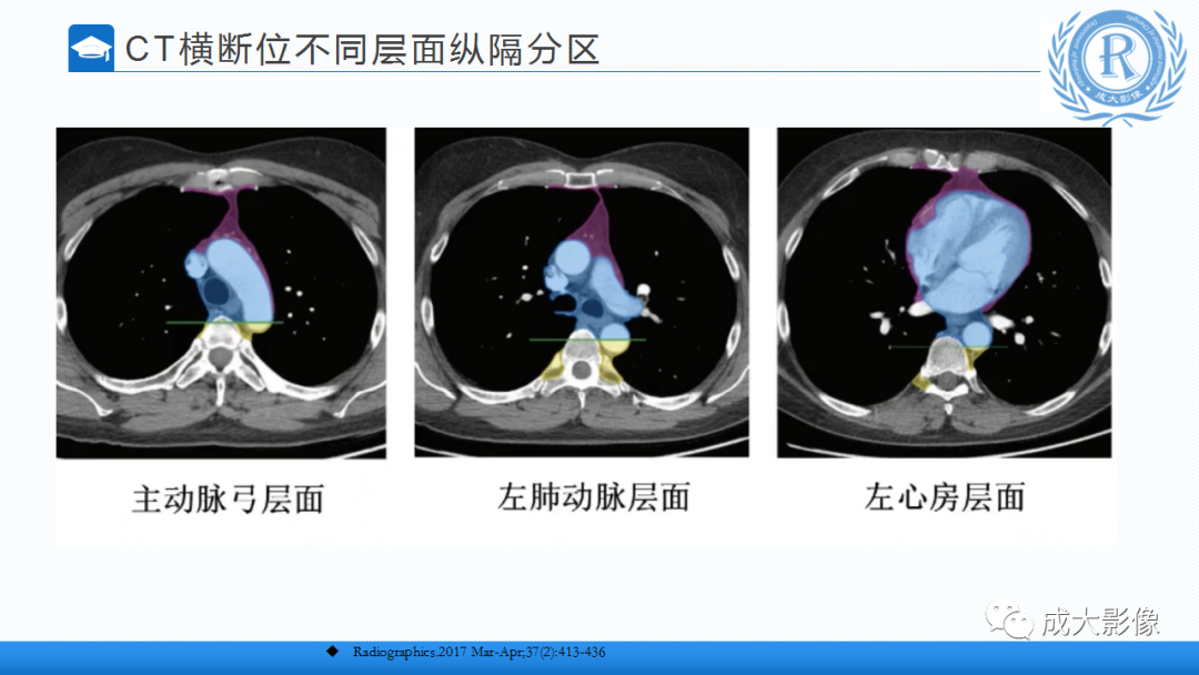 影像PPT - 【PPT】纵隔常见肿瘤及瘤样病变的诊断思路-4