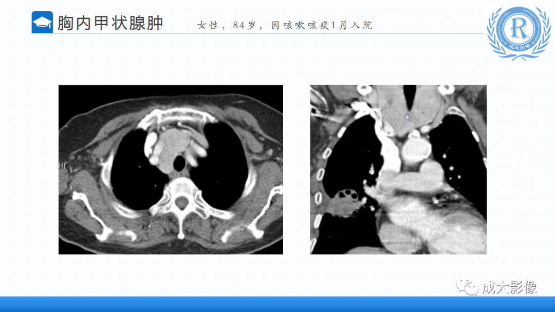 影像PPT - 【PPT】纵隔常见肿瘤及瘤样病变的诊断思路-12