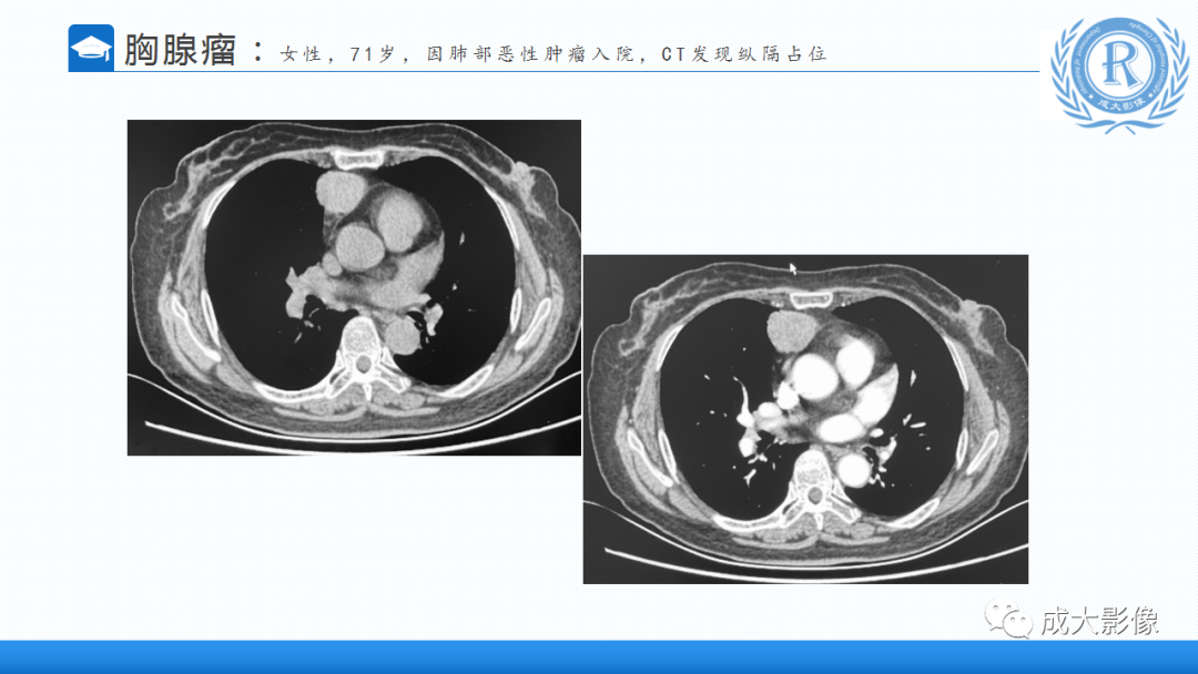 影像PPT - 【PPT】纵隔常见肿瘤及瘤样病变的诊断思路-15