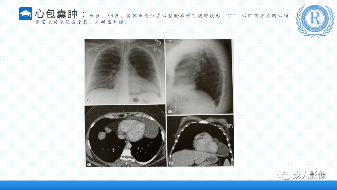 影像PPT - 【PPT】纵隔常见肿瘤及瘤样病变的诊断思路-20