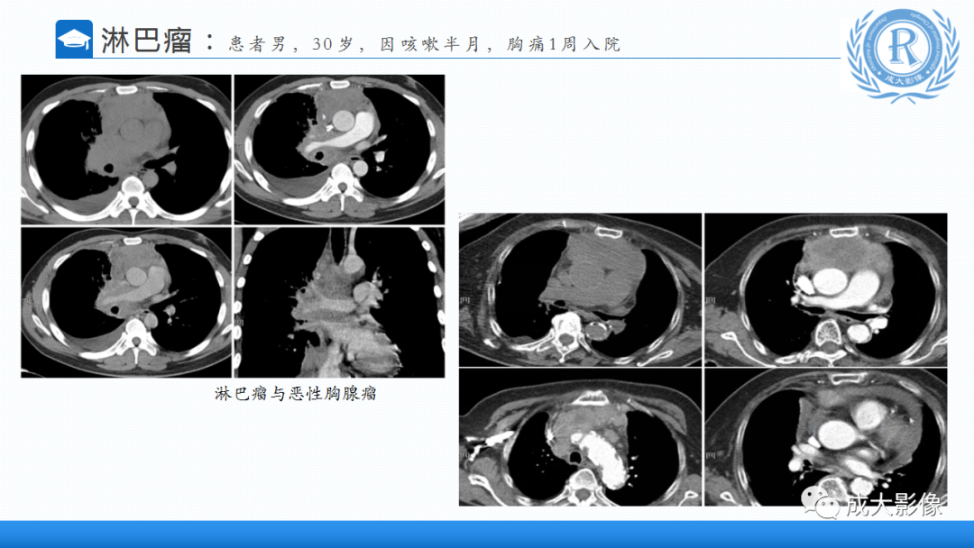 影像PPT - 【PPT】纵隔常见肿瘤及瘤样病变的诊断思路-22