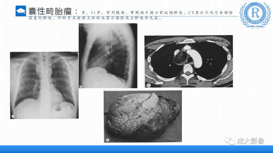 影像PPT - 【PPT】纵隔常见肿瘤及瘤样病变的诊断思路-25