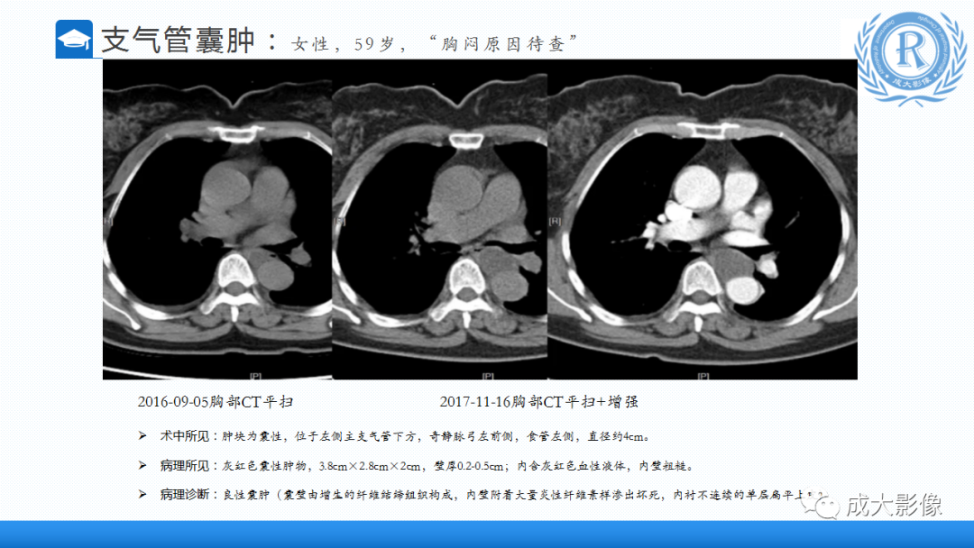 影像PPT - 【PPT】纵隔常见肿瘤及瘤样病变的诊断思路-28